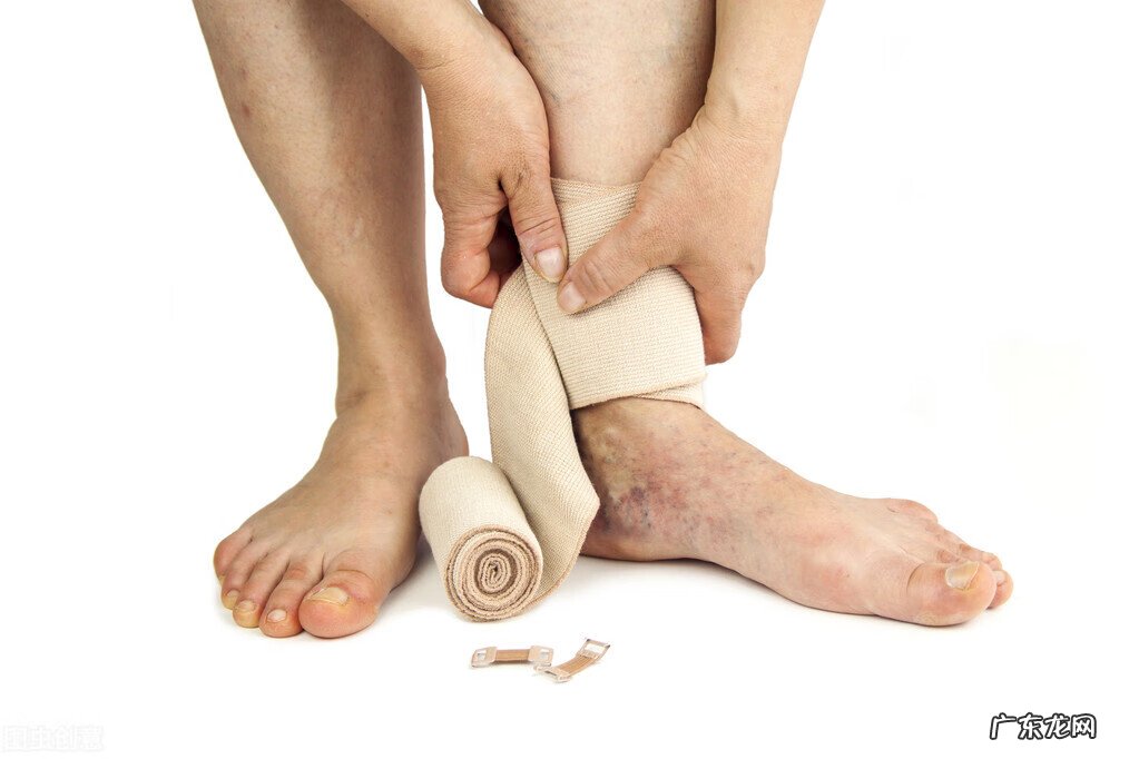 静脉曲张怎么治疗最佳方法 静脉曲张怎么治疗才能好