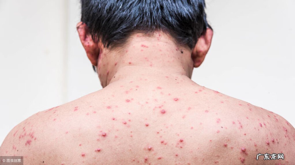 长了水痘一般多少天能好 大人发水痘几天能好