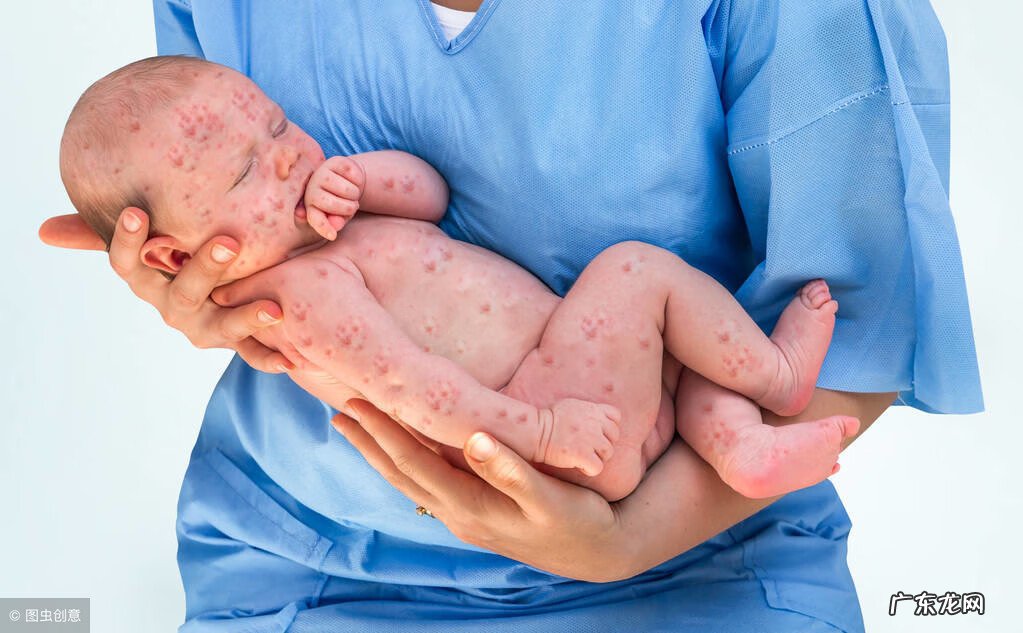 长了水痘一般多少天能好 大人发水痘几天能好