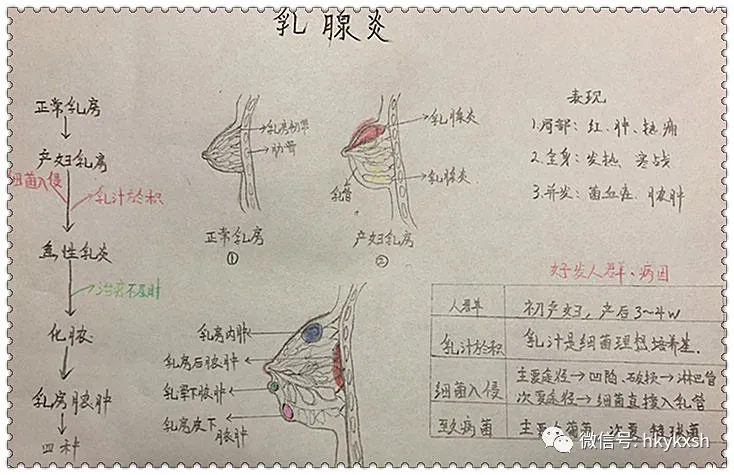 乳腺炎怎么调理最好方法 急性乳腺炎怎么办