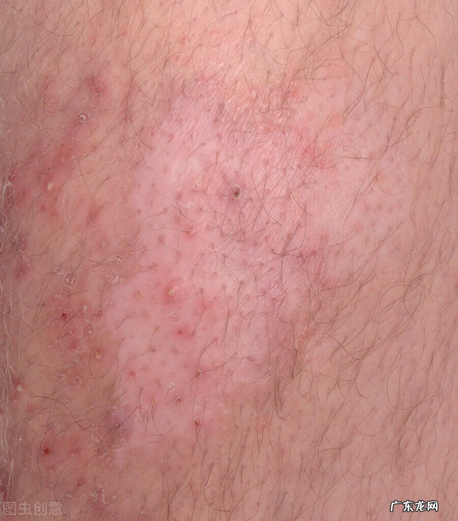 小块白斑的治愈最好方法 白癜风早期能治愈吗