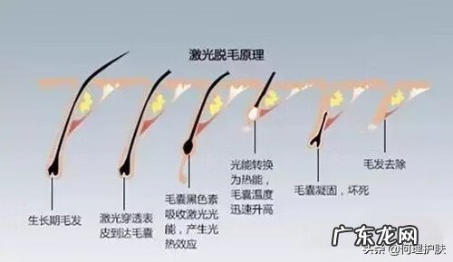 激光脱毛去胡子效果