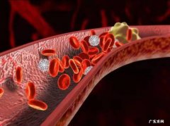 静脉曲张自己怎么调理 静脉曲张怎样调理才能好