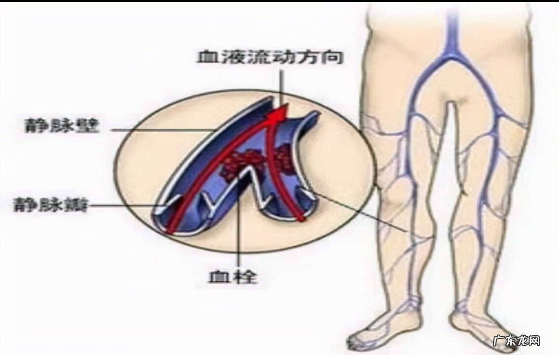 静脉曲张自己怎么调理 静脉曲张怎样调理才能好