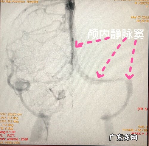 产后头疼的原因 产后头痛是怎么回事