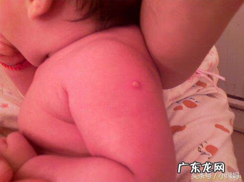 婴儿卡介苗一定要复查吗 卡介苗复查怎么做