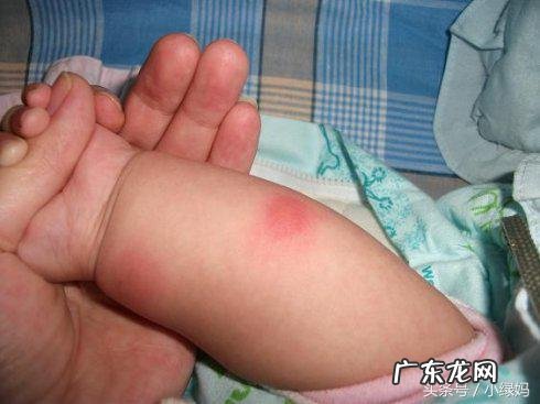 婴儿卡介苗一定要复查吗 卡介苗复查怎么做