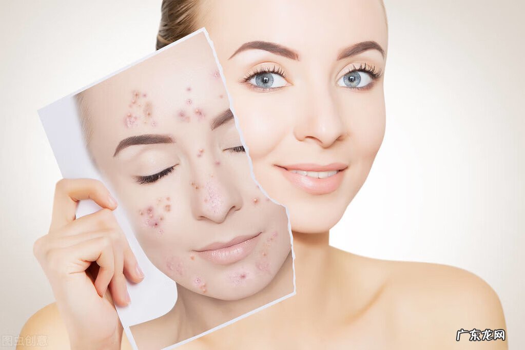 青春痘形成的原因是什么 青春痘是怎样引起的