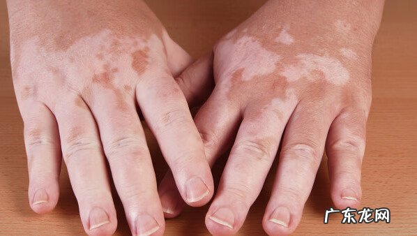 长白斑会传染吗 白风癜传染吗