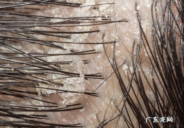 头皮屑特别多是怎么回事 头皮屑多是什么原因造成的