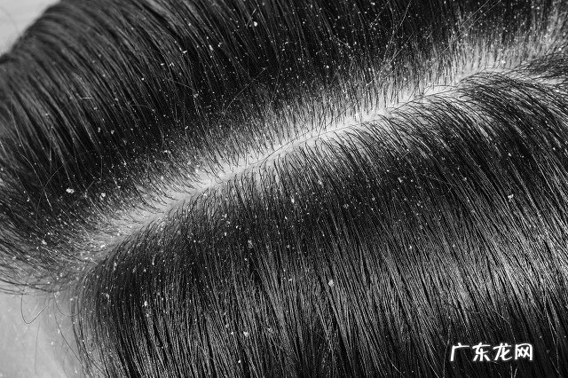 头皮屑特别多是怎么回事 头皮屑多是什么原因造成的