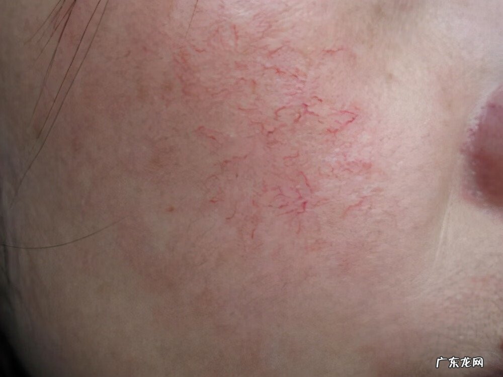 脸上有一点红血丝怎么办 面部有红血丝怎么回事