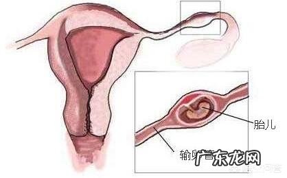 怎样才能够避免宫外孕?