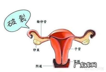 怎样才能够避免宫外孕?