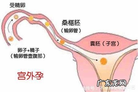 怎样才能够避免宫外孕?