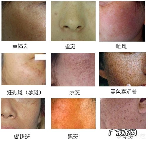 斑是怎么形成的?