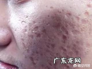 如何清除脸上的痘印啊？