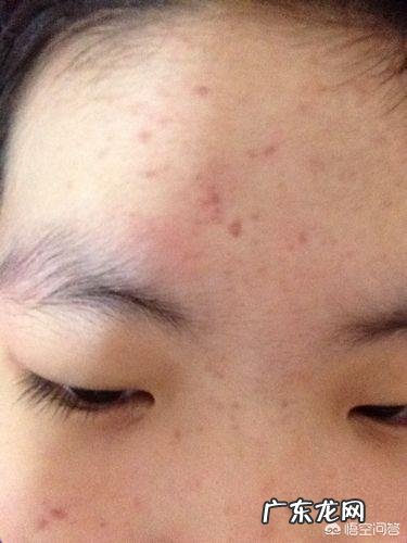 如何清除脸上的痘印啊?