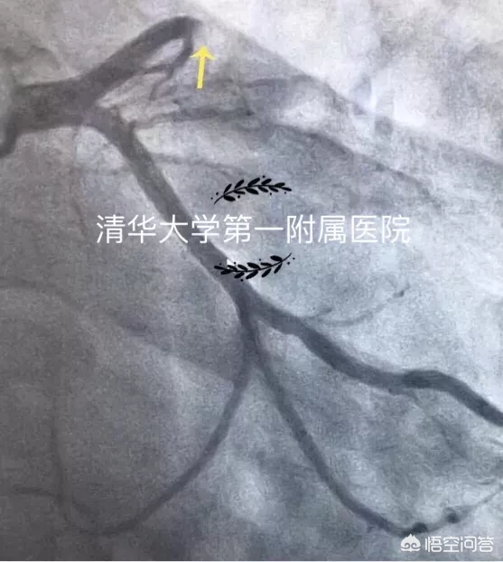 心肌梗死与心肌梗塞有什么区别吗?