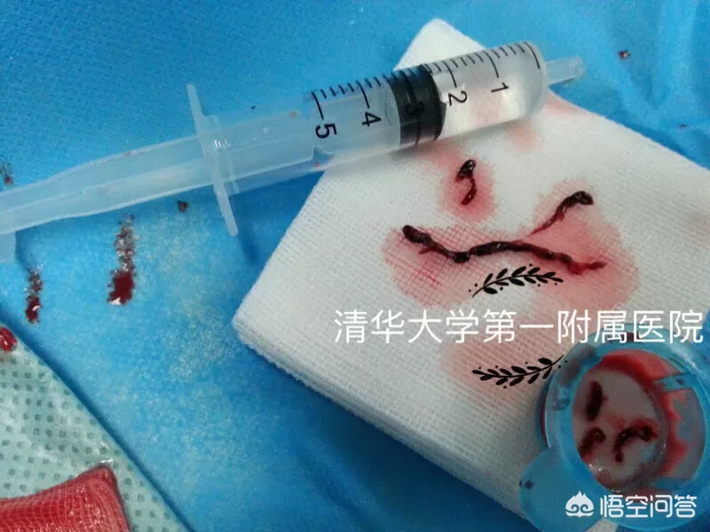 心肌梗死与心肌梗塞有什么区别吗?