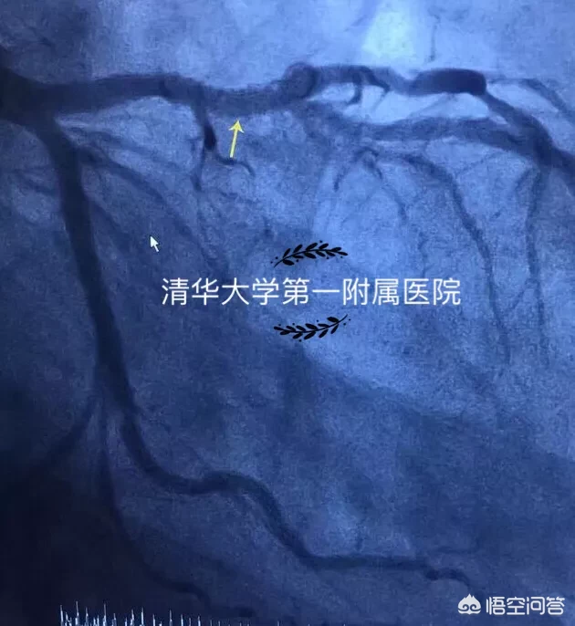 心肌梗死与心肌梗塞有什么区别吗?