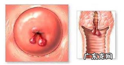 子宫息肉必须手术吗?