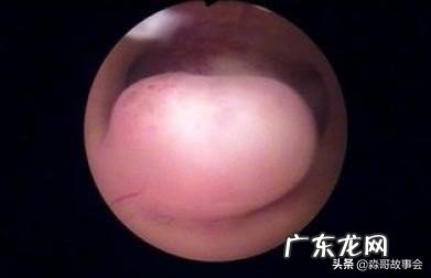 子宫息肉必须手术吗？