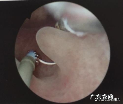 子宫息肉必须手术吗？