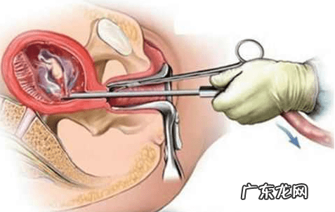 刮宫手术 刮宫术是什么意思