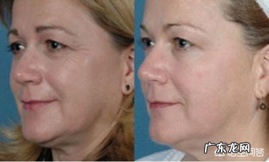 如何去除额头的皱纹?