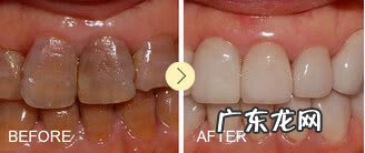 四环素牙怎么瞬间美白 四环素牙如何美白?