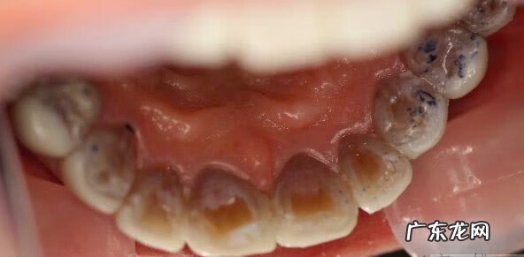 四环素牙怎么瞬间美白 四环素牙如何美白?