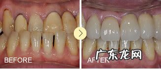 四环素牙怎么瞬间美白 四环素牙如何美白?