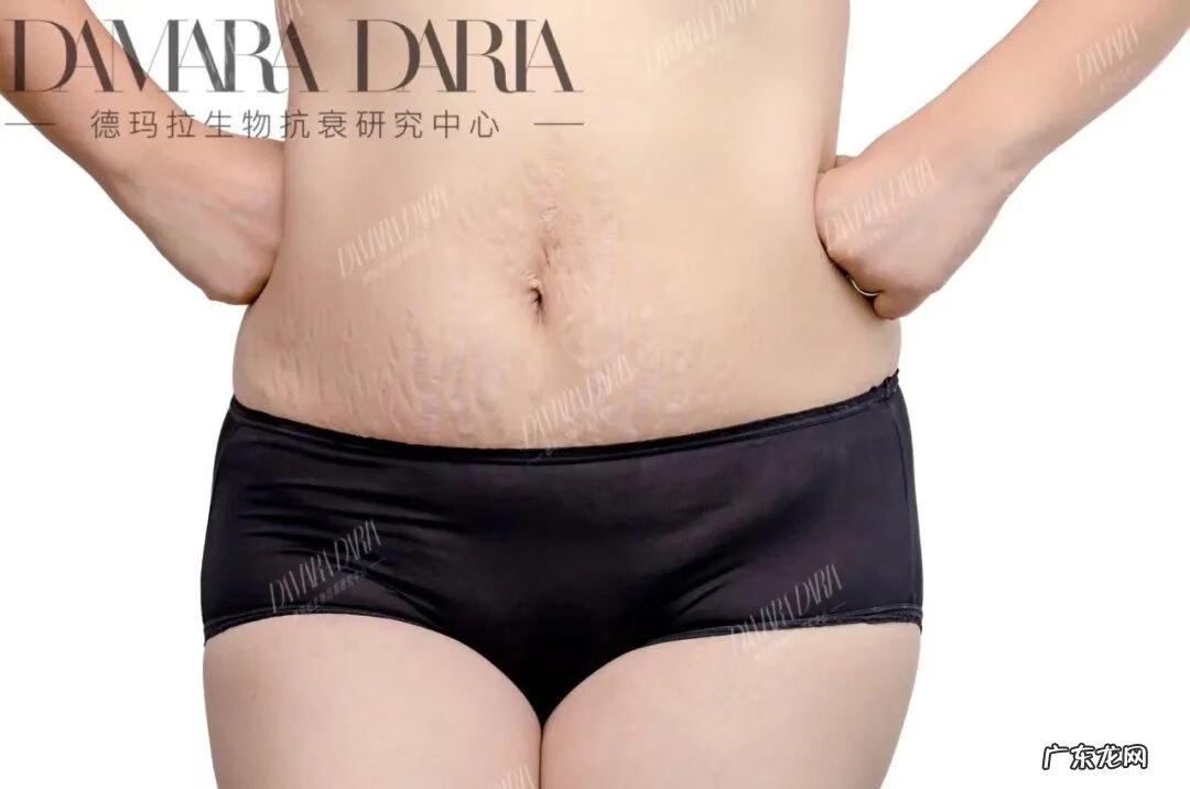 妊娠纹 去妊娠纹是什么原理