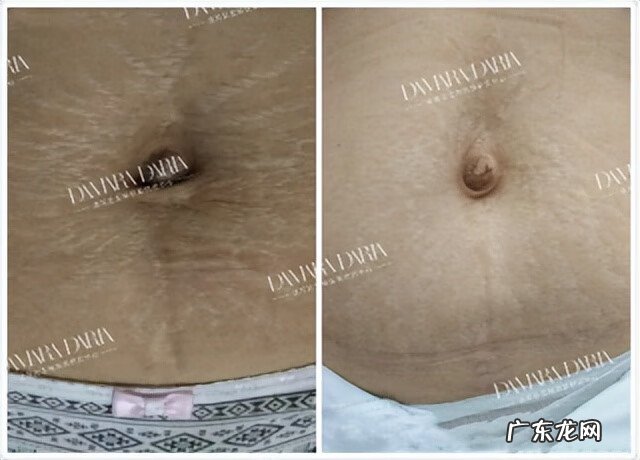妊娠纹 去妊娠纹是什么原理