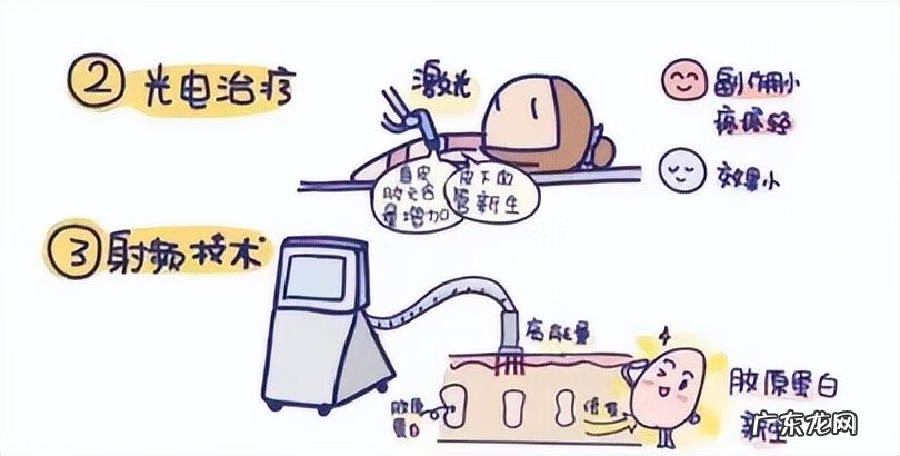 妊娠纹 去妊娠纹是什么原理