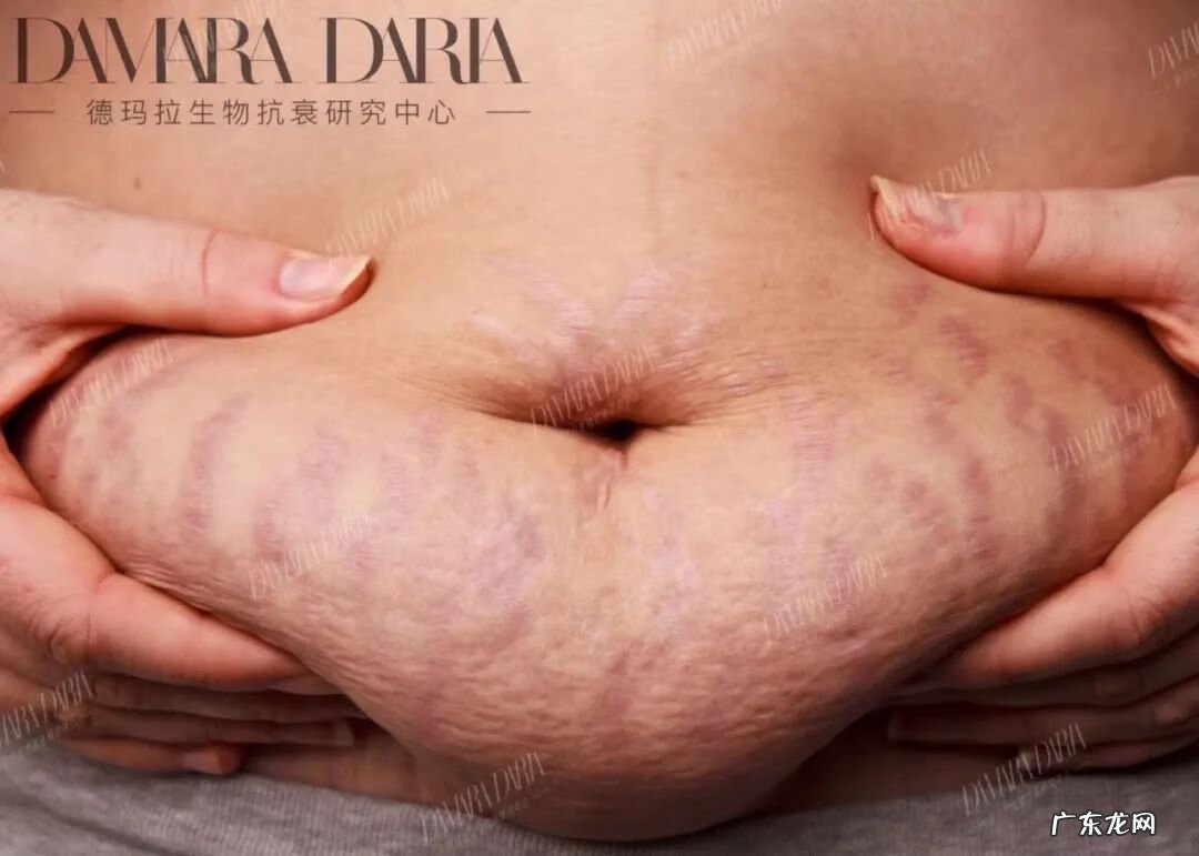 妊娠纹 去妊娠纹是什么原理