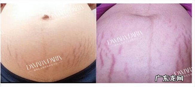 妊娠纹 去妊娠纹是什么原理