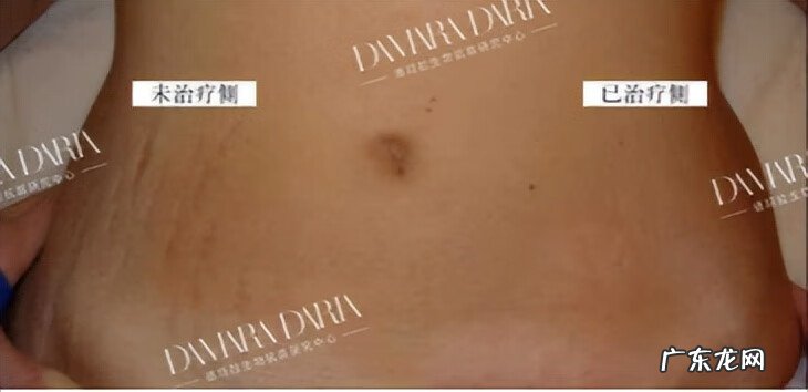 妊娠纹 去妊娠纹是什么原理