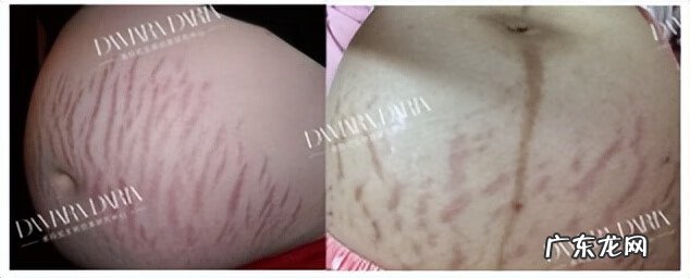妊娠纹 去妊娠纹是什么原理