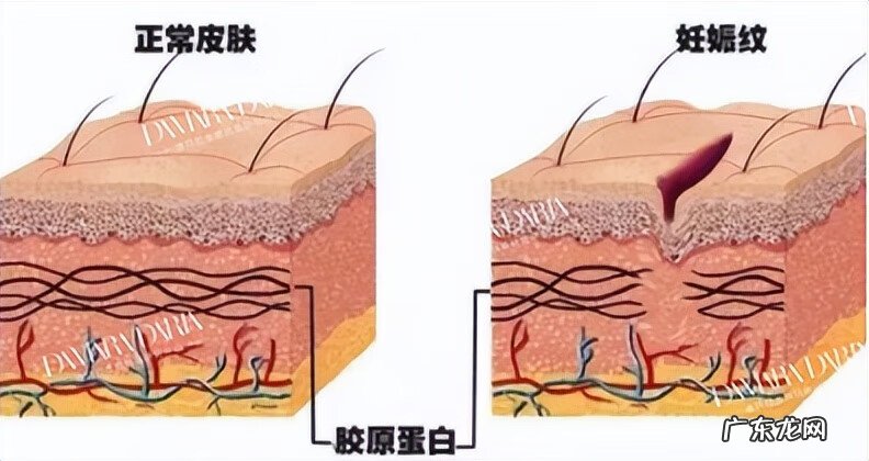 妊娠纹 去妊娠纹是什么原理