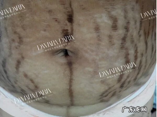 妊娠纹 去妊娠纹是什么原理