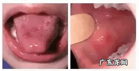 小儿手足口病的症状图片 小孩手足口病症状初期