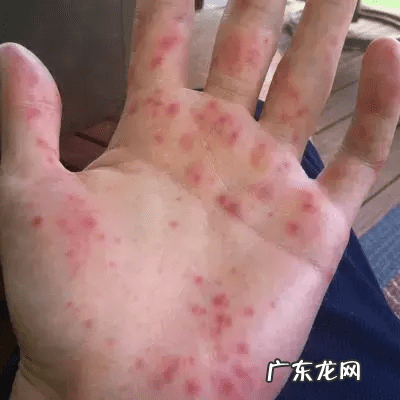 小儿手足口病的症状图片 小孩手足口病症状初期