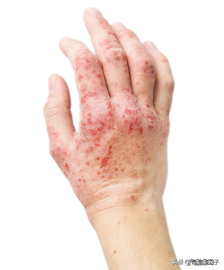 治疗湿疹最好方法 湿疹是如何治疗