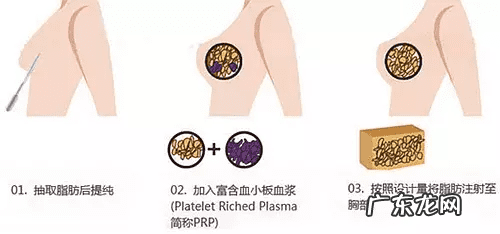 怎样让胸变得越来越大 明星怎么隆胸