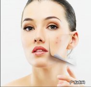 青春痘的治疗最佳方法 青春痘治疗的方法