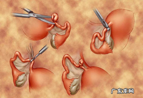 结扎男性对身体有害吗 男性结扎的好处和坏处图片