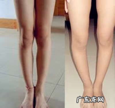 宝宝罗圈腿怎么判别 宝宝罗圈腿怎么办