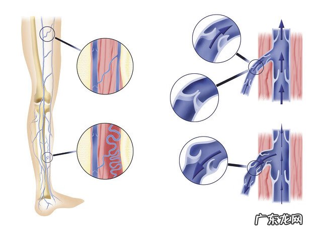 静脉曲张如何形成的 静脉曲张怎样形成的原因